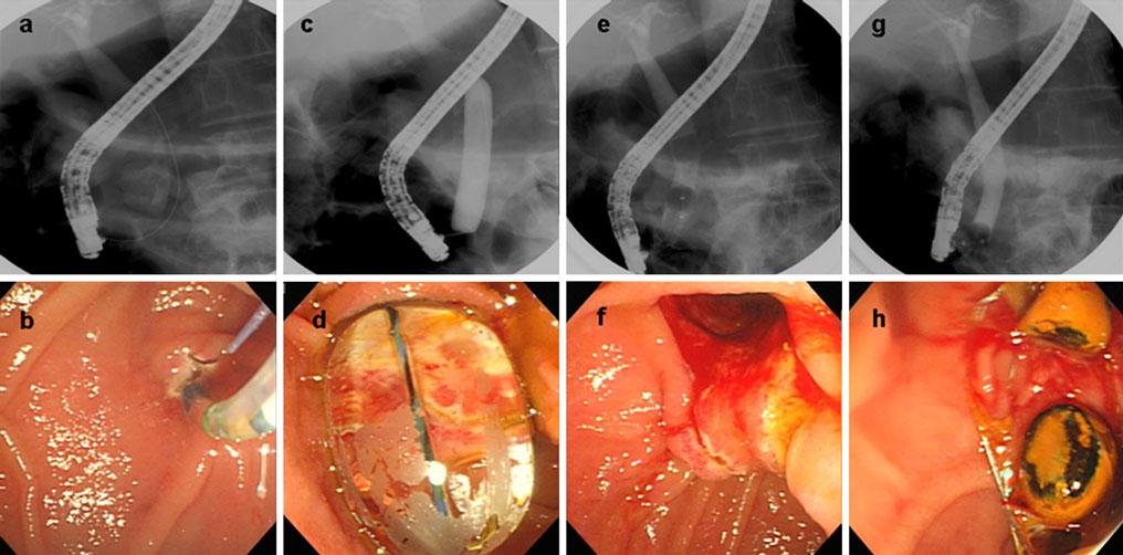 1574 Dig Dis Sci (2011) 56:1572 1577 Fig. 1a h Endoscopic papillary large balloon dilatation (EPLBD) procedure.