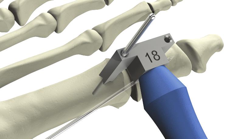 The drill guide is positioned dorsally, over the osteotomy line.