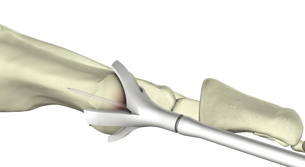Incision & Joint preparation A medial longitudinal incision is commonly used to expose the joint. The surfaces are prepared with flat cuts or a Cup-and-Cone configuration.