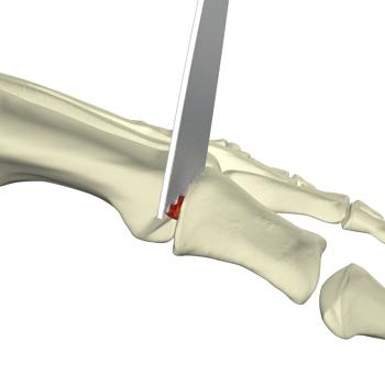 Metatarsal Preparation Option 1: Flat cuts technique Proceed to the metatarsal head resection with an oscillating saw.
