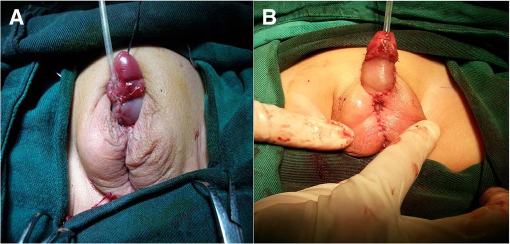 o et l. BC Urology (2017) 17:21 Pge 3 of 7 Fig. 2 he ppernce fter the first stge of twostge techniques we routinely used in urethroplsty. Plte reconstruction with twostge tubulriztionurethroplsty.
