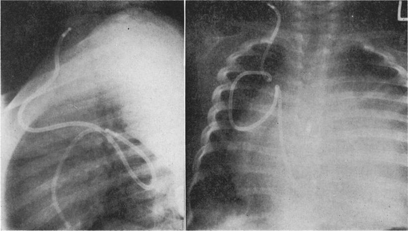 X-ray film 2 weeks after shunt revision showing the catheter tip turned to the right in the right atrium; the patient developed signs of tamponade.