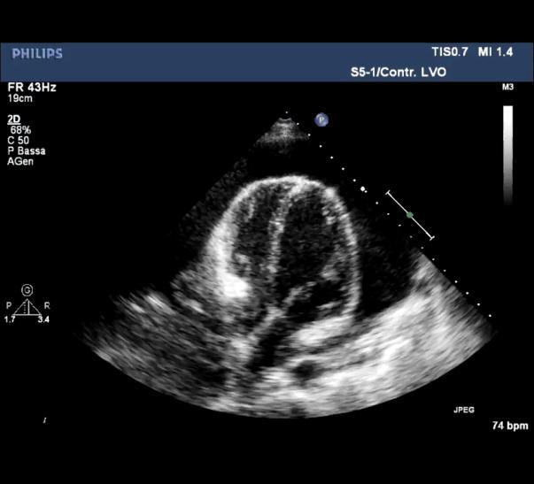 Accumulation of pericardial fluid under pressure leading to impaired