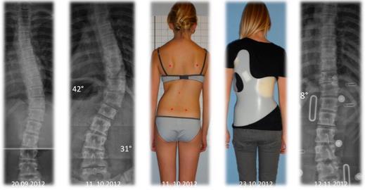 The average improvements were exceeding 5 both thoracic as well as lumbar and therefore are exceeding the technical error.
