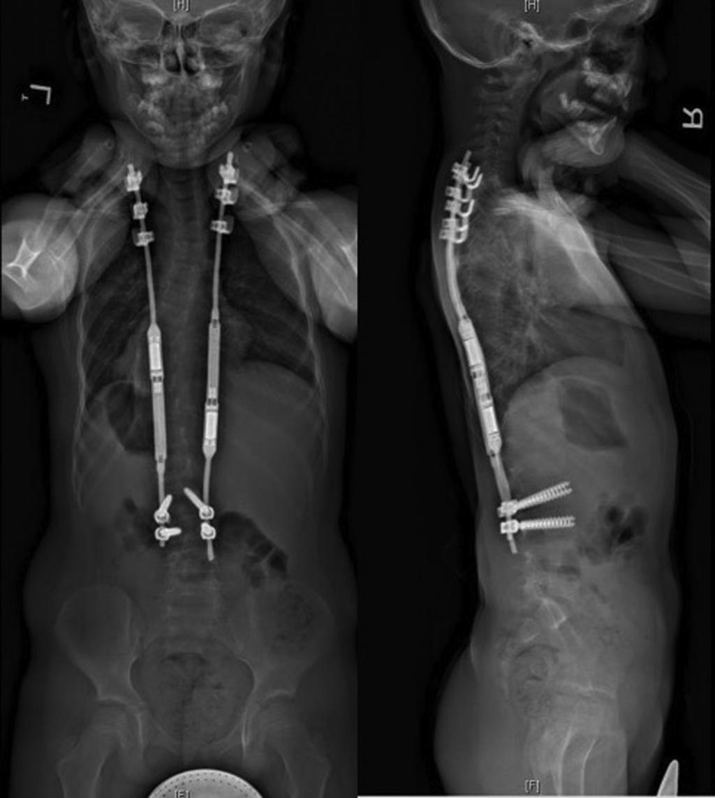 Rib-based anchors 243 Figure 2 Example of a rib-to-spine hybrid growing-rod construct in a patient with idiopathic EOS. constructs.