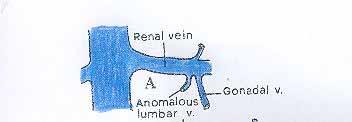 Lumbar vein entering in left renal vein