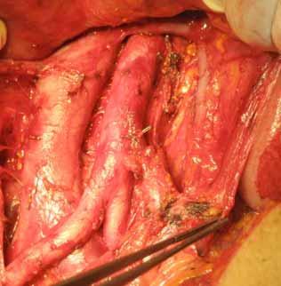 SURGICAL APPROAC TO THE RETROPERITONEUM: LOMBOAORTIC