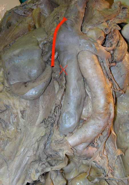 OVARIAN VEIN ANOMALIES Ovarian vein in quite rare number of patients (0,3%), could