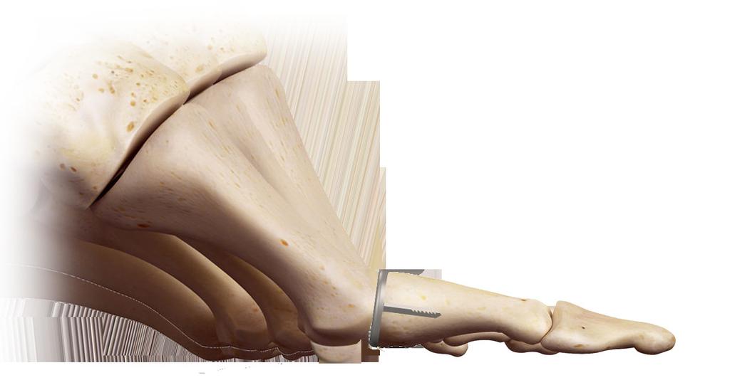 The BioPro First MPJ Hemi Implant The proven long-term joint fusion alternative.