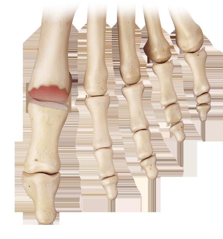 How it works In a healthy functioning joint, smooth cartilage covers both ends of the bone.