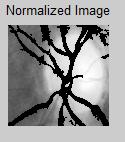 This is normalized and feature extraction is performed. Local binary pattern of the optic disc disc is extracted.