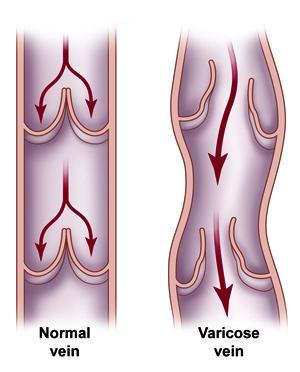 Anatomy Varicose Veins Varicose veins are veins that have become enlarged and twisted. One cause of valve failure is deep vein thrombosis (DVT), which can cause permanent damage to the valves.
