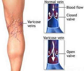 Varicosis Varicosis in general refers to distended veins. It derives from the Latin word for twisted, "varix".