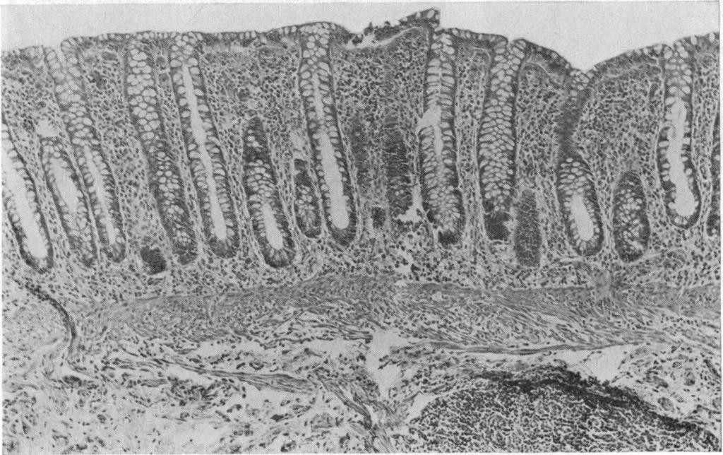 com/ flammatory cells in the superficial lamina propria associated with oedema and congestion, degenerative or reactive changes in the epithelium of the superficial part of the crypts and the mucosal