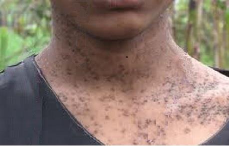 Dermatitis from chronic arsenic toxicity.