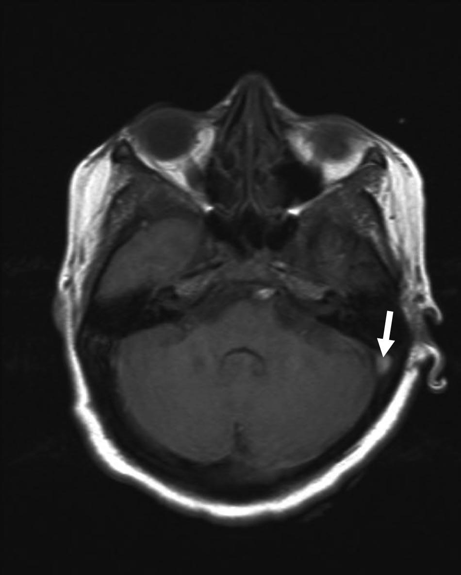 1168 Stroke April 2011 Figure 6. T2-weighted magnetic resonance image showing high-intensity bland venous infarct in frontal lobe. Figure 5.
