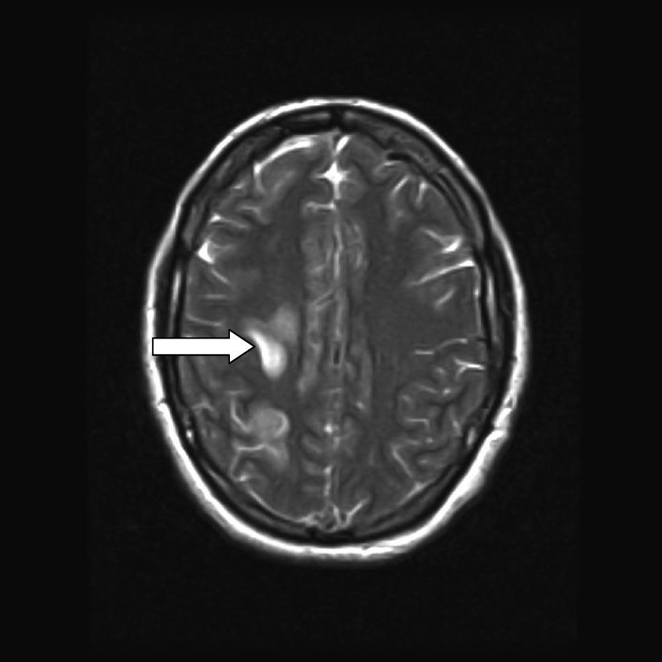 The secondary signs of MRI may show similar patterns to CT, including cerebral swelling, edema, and/or hemorrhage.