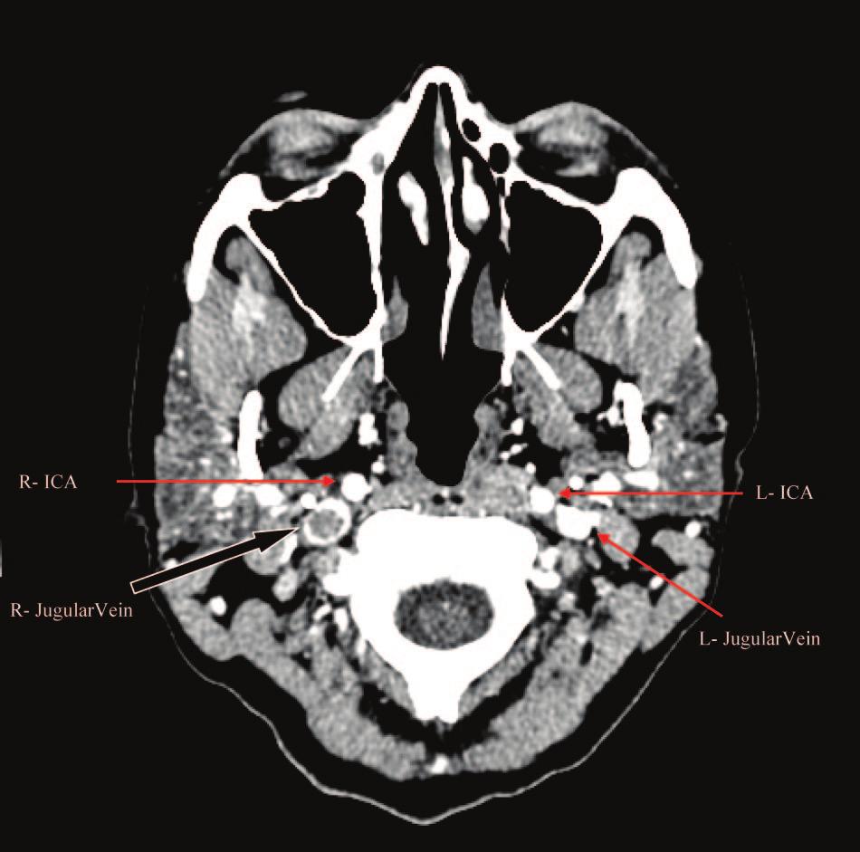 Figure 8. T2-weighted magnetic resonance image showing mixed hypointensity (white arrow) and isointensity (black arrow) signals representing an acute hemorrhage at left parietal lobe.