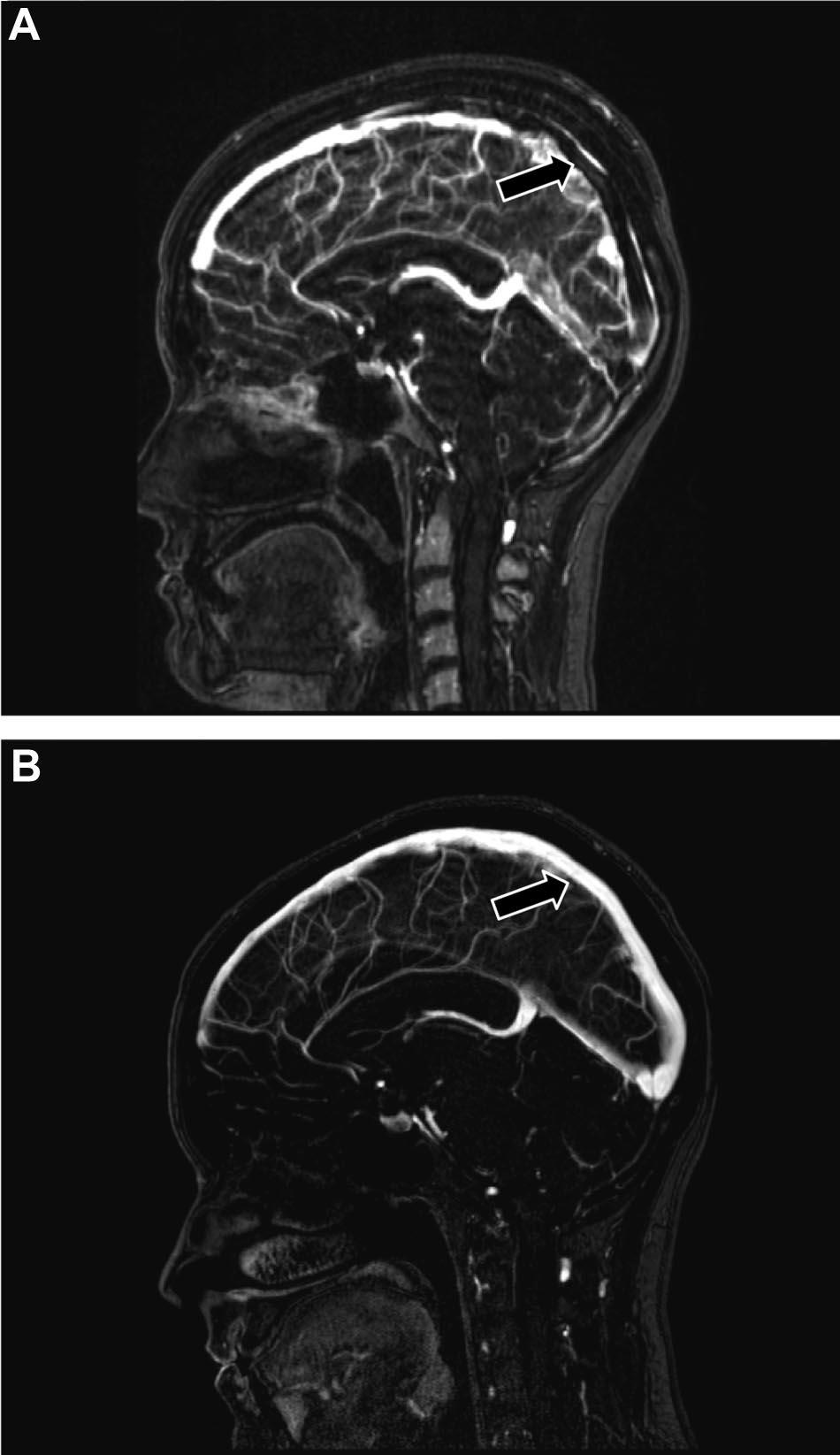 1170 Stroke April 2011 Figure 13. Noncontrast computed tomographic scan in a newborn with deep cerebral venous thrombosis and bilateral thalamic (white arrows) infarcts. Figure 12.