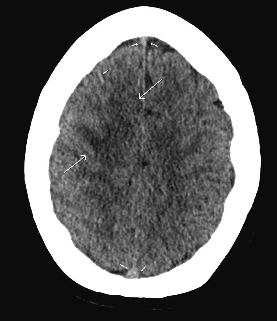 The direct venogram also showed collateral cortical veins.