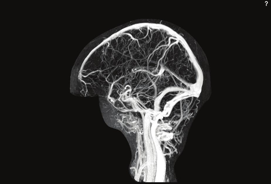 1164 Stroke April 2011 Cortical veins 17% Posterior frontal vein Trolar vein Anterior frontal vein Superior sagital sinus 62% Deep venous system 11% Straight sinus 18% Transverse (lateral) sinus
