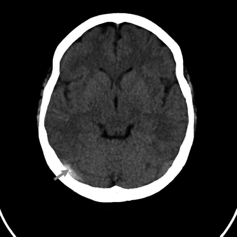 1166 Stroke April 2011 Figure 3. Noncontrast computed tomography head scan showed spontaneous hyperdensity of right transverse sinus. a dense triangle, the dense or filled delta sign.