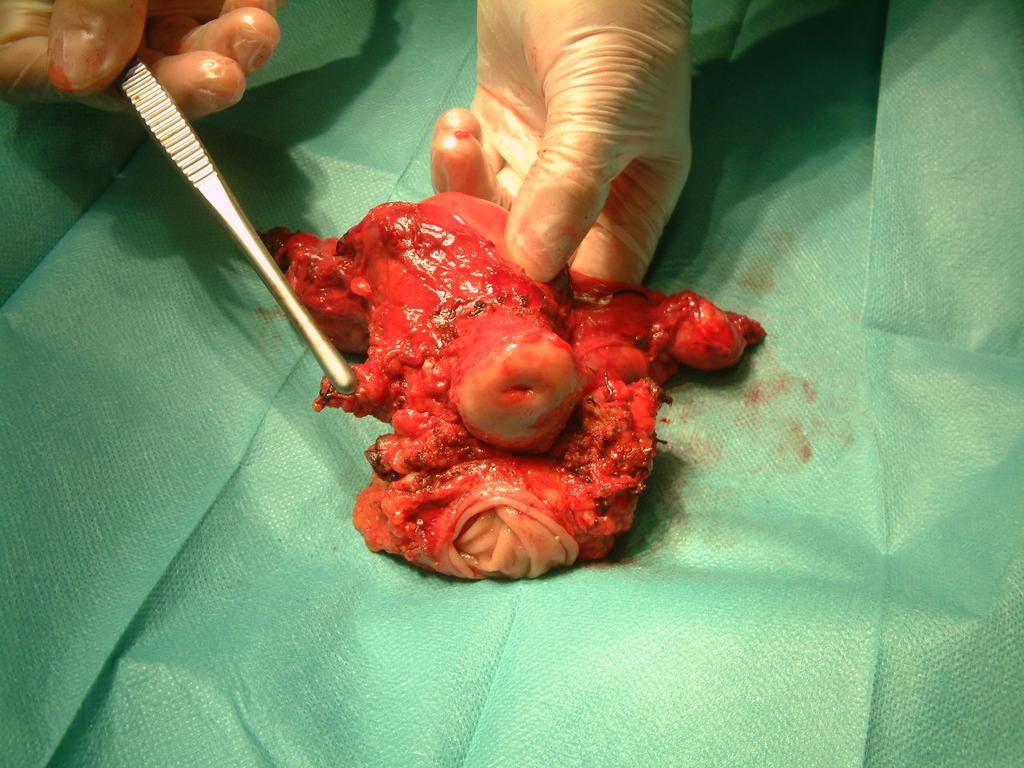 ENDOMETRIOSIS SOME IMPORTANT CONCEPTS IMPORTANCE OF PRESURGICAL STAGING: - Several