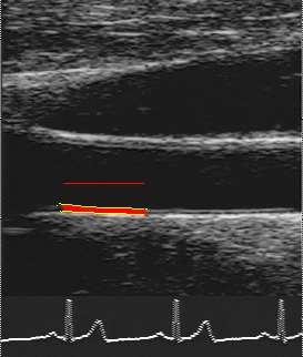BMJ 212;345:e649 Carotid Artery Wall Imaging Carotid Artery Intima-media Thickness (CIMT Skin surface Far wall carotid artery Scanner Transducer Jugular vein Common Carotid artery 5 4.5 p trend <.