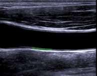 maximal CIMT by high-resolution carotid artery ultrasound o