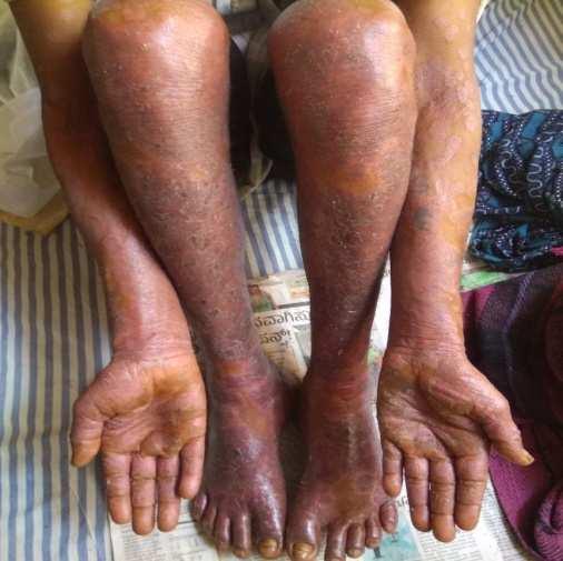 Nitya Anulomana Kadu, Pidaka Varnya Blackish discolouration, Rukshatva Dryness and itching CONCLUSION Before Treatment After Treatment The prevalence of Kitibha Kushta is increasing day by day.