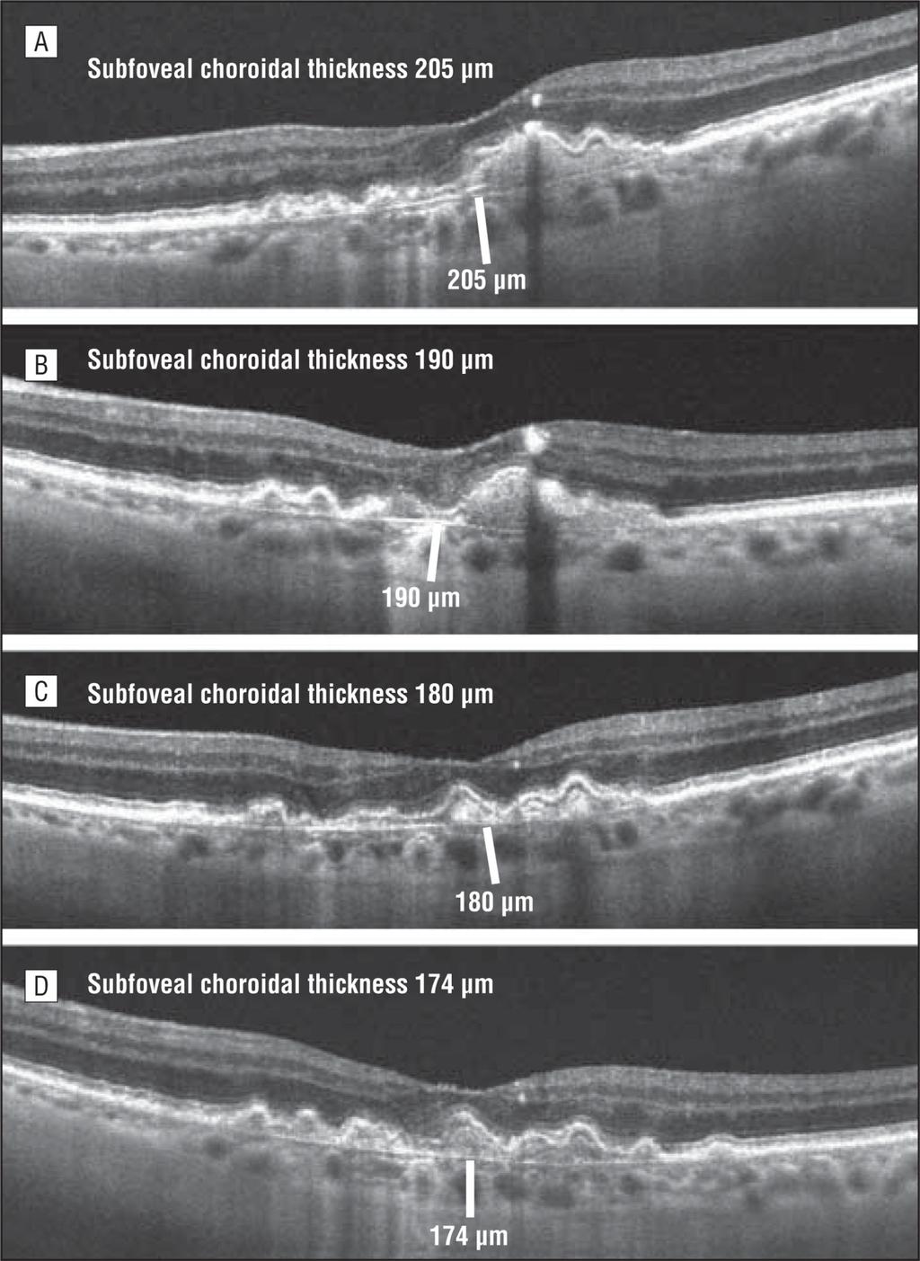 Branchini et al. Page 4 Figure 1. Spectral-domain optical coherence tomographic scans showing choroidal thicknesses of the same subject at 4 different times.