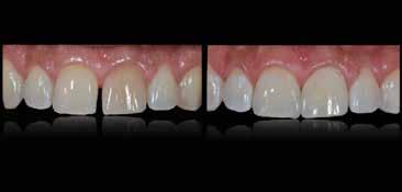 It is essentially the only Australian A to Z veneer course of its kind, taught by well-respected internationally renowned Maxim Belograd and Oral Design lab