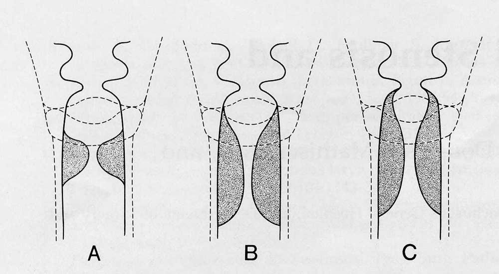 Figure 1. Diagrams of typical distribution of idiopathic tracheal and laryngotracheal stenosis.