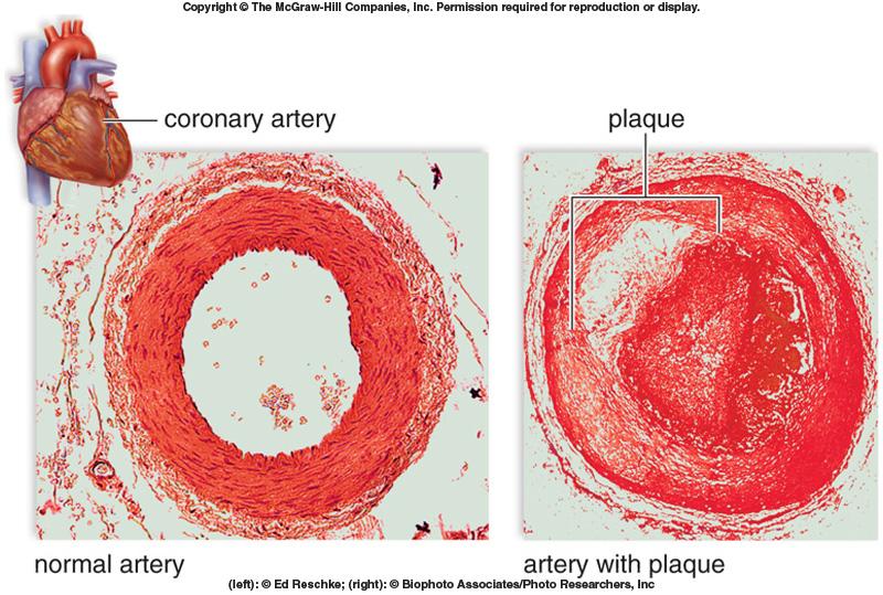A build up of plaque in blood vessels Plaque that is stationary is called a thrombus and an embolus when