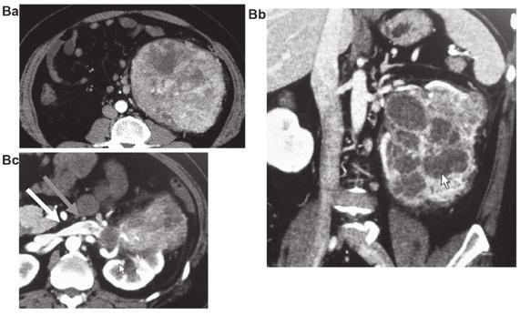 TAKEUCHI et al: TARGETED THERAPIES OF RCC CONSIDERING THE PATIENT'S LIFE STAGE 3979 Figure 3. CT scans of Case 2 with metastatic renal cell carcinoma at different time points.