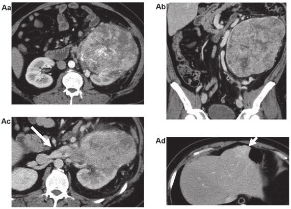 (A) CT scans prior to the initiation of treatment with pazopanib of the left kidney; (Aa) coronal, (Ab), sagittal, (Ac) embolus in the renal vein (white arrow) and (Ad) a round metastatic site