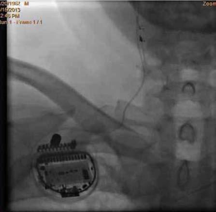 Implant and Stimulation Protocol VNS Implanted System Implant
