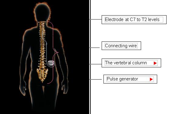 Thoracic Spinal Cord Stimulation for Heart Failure as a Restorative Treatment (SCS HEART