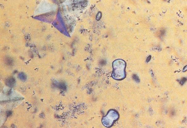 Calcium oxalate monohydrate crystals are colorless and can assume several shapes, including ovoids, biconcave disks, rods and dumbbells (above right, yellow arrows).