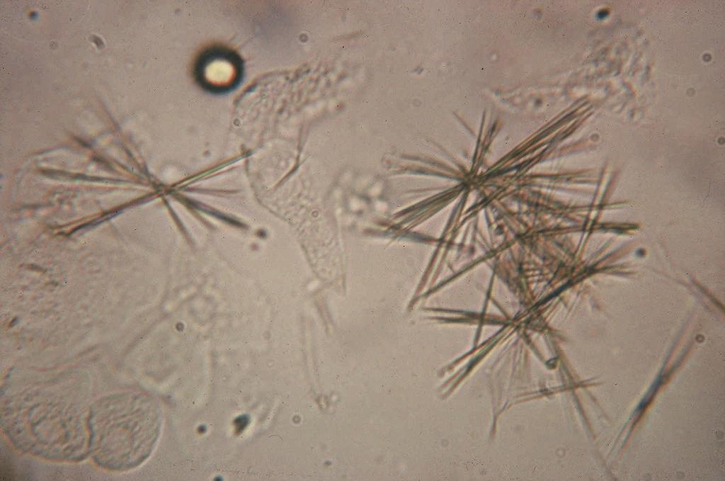 Urinary crystals can also be seen in patients taking certain medications. One example is sulfadiazine: these crystals appear as striated shells or "shocks of wheat.