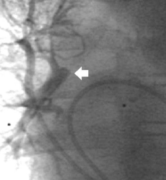 Pulmonary vein wedge angiography demonstrated retrograde filling of a 7 mm in diameter distal RPA with right upper, middle, and lower lobe branches (fig 4).