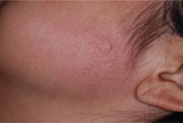 SEVERE URTICARIA AFTER LASER TREATMENT after her second treatment. A test spot was performed, and she developed immediate urticaria after treatment (Figure 1).