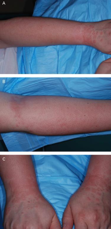 treated using an 810-nm diode laser with contact cooling using 22 J/cm 2 with a 30-ms pulse duration (Light Sheer Laser, Lumenis Incorporated, Santa Clara, CA).