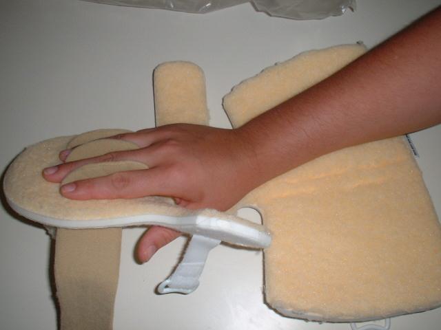 Application of Roylan Wrist Splint Figure 1.