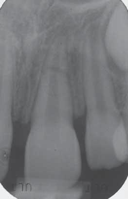 Fig. 1a An 8-year-old patient presented with a fracture in the apical third of tooth 21. Fig. 1b Five years after trauma, the root-fractured tooth 21 shows pulp canal obliteration in both fragments.