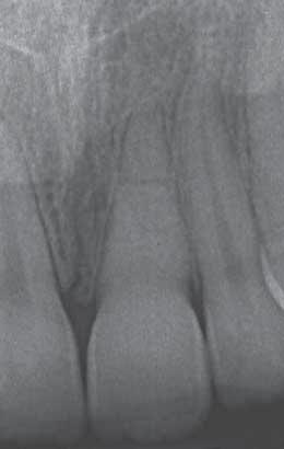 2b Two years post-traumatically, tooth 21 shows normal pulpal healing with a vital pulp.
