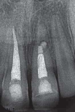 endodontic obliteration (vital pulp) treatment treatment after pulpal necrosis Enamel fracture 2 0 0 1 3 Uncomplicated crown fracture 1 0 0 0 1 Complicated crown fracture 2 0 0 0 2 Total teeth 5 0 0