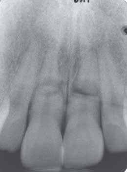 Permanent teeth with horizontal root fractures after dental trauma Research and Science Fig.