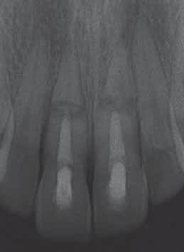 4c One year post trauma, the radiographs of both teeth 11 and 21 showed external root resorption. The authors assume that contaminated tissue was intruded between the fragments.