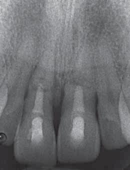 Three of these 8 teeth wrongly received endodontic treatment of both fragments, and one tooth had excess filling material between the fragments. Andreasen et al.